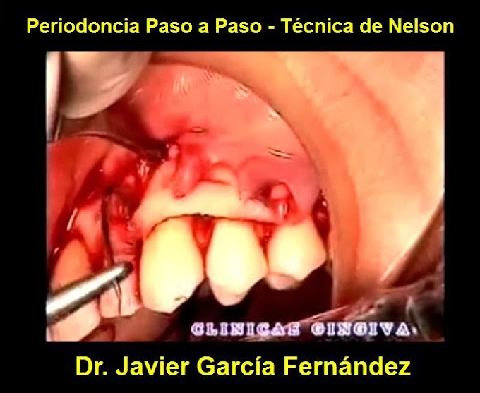 PERIODONCIA Paso a Paso - Técnica de Nelson (Dr. Javier García Fernández)