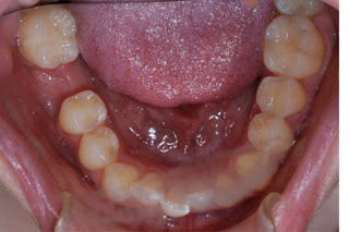  Mất đi răng hàm số 6 đồng nghĩa với việc lực nhai của hàm bị yếu đi ít nhiều