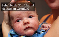 Bebeklerde Süt Alerjisi Ne Zaman Görülür? Süt Alerjisi Olmuş Bebek Fotoğrafı