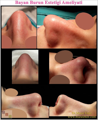 Rhinoplasty Istanbul - Rhinoplasty in Istanbul - Rhinoplasty Turkey - Rhinoplasty in Turkey – Rhinoplasty doctor in Istanbul – ENT doctor in Istanbul - Nose Job in Istanbul - Female Nose Aesthetic Surgery - Nose Jobs For Women - Nose Reshaping for Women - Best Rhinoplasty For Women Istanbul - Female Rhinoplasty Istanbul - Nose Job Surgery for Women - Women's Rhinoplasty - Nose Aesthetic Surgery For Women - Female Rhinoplasty Surgery in Istanbul - Female Rhinoplasty Surgery in Turkey Rhinoplasty Istanbul - Rhinoplasty in Istanbul - Rhinoplasty Turkey - Rhinoplasty in Turkey – Rhinoplasty doctor in Istanbul – ENT doctor in Istanbul - Nose Job in Istanbul - Female Nose Aesthetic Surgery - Nose Jobs For Women - Nose Reshaping for Women - Best Rhinoplasty For Women Istanbul - Female Rhinoplasty Istanbul - Nose Job Surgery for Women - Women's Rhinoplasty - Nose Aesthetic Surgery For Women - Female Rhinoplasty Surgery in Istanbul - Female Rhinoplasty Surgery in Turkey