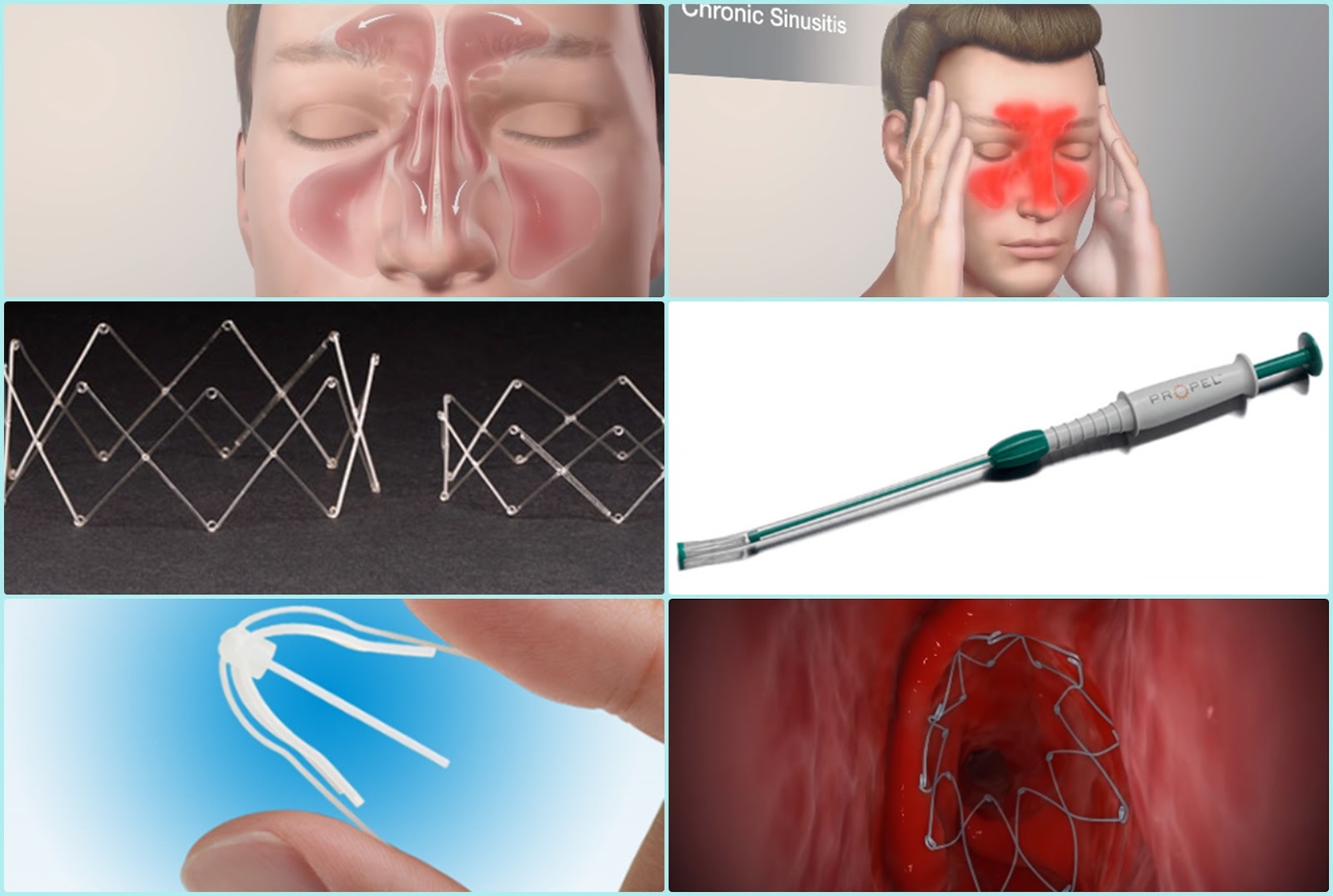 Intranasal Implant Releasing Controlled Cortisone Propel Sinus Implant