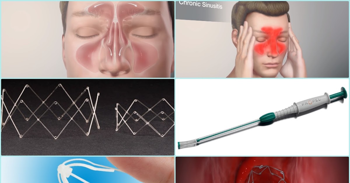 Intranasal Implant Releasing Controlled Cortisone Propel Sinus Implant