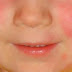 SCARLET FEVER IS BACK AND EVERY PARENT NEEDS TO WATCH OUT FOR THESE WARNING SIGNS