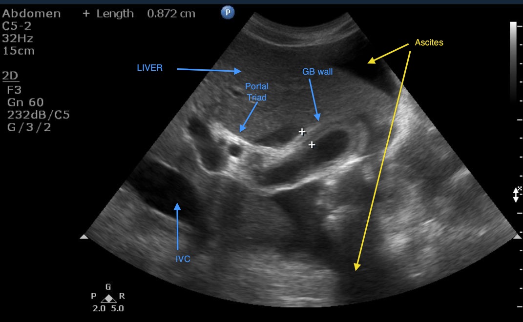 Emory Emergency Ultrasound Gallbladder Wall Thickening Cholecystitis