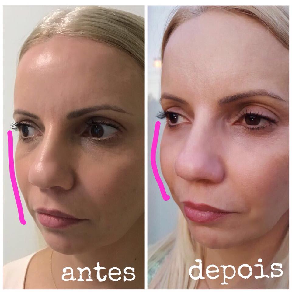 Preenchimento Do Malar Antes E Depois Preenchimento Do Malar Antes E Depois