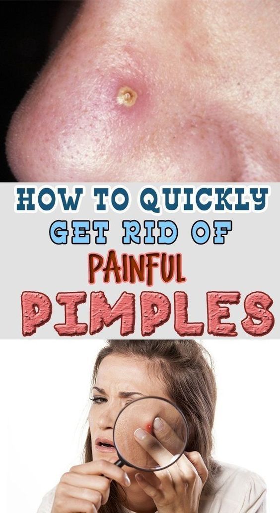 the-best-ways-to-get-rid-of-pimples-on-nose-fast-and-overnight