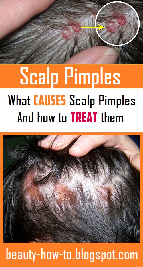 Scalp Pimples What Causes Them And How To Treat Them How To Beauty