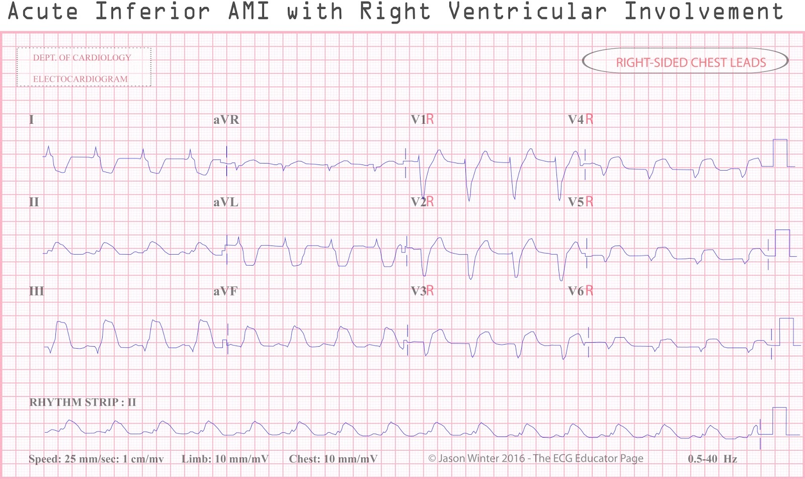 acute coronory syndrome Abbreviation: acs refers to a spectrum of conditions compatible with acute myocardial ischemia and/or infarction that are usually due to an abrupt reduction in coronary. acute coronory syndrome Abbreviation: acs refers to a spectrum of conditions compatible with acute myocardial ischemia and/or infarction that are usually due to an abrupt reduction in coronary.