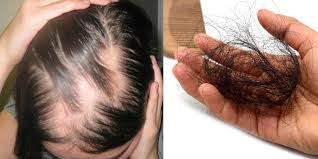 6 cách chữa rụng tóc hiệu quả từ dược liệu thiên nhiên