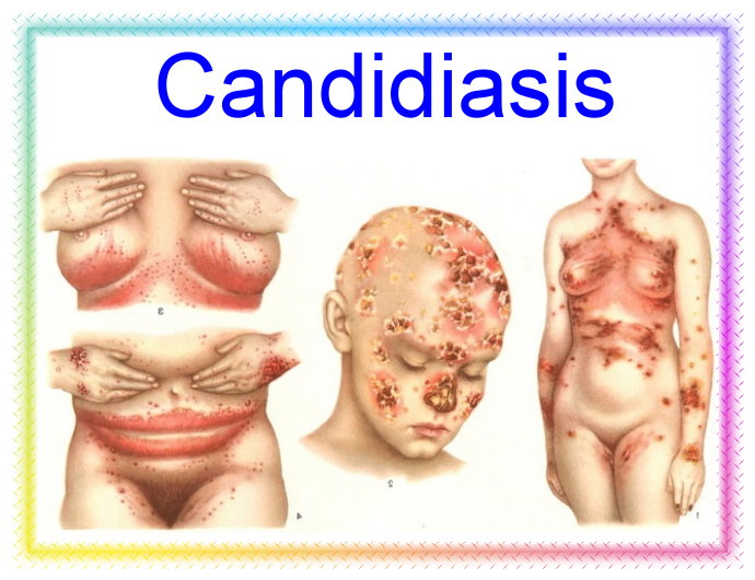 Candidiasis intestinal como se detecta