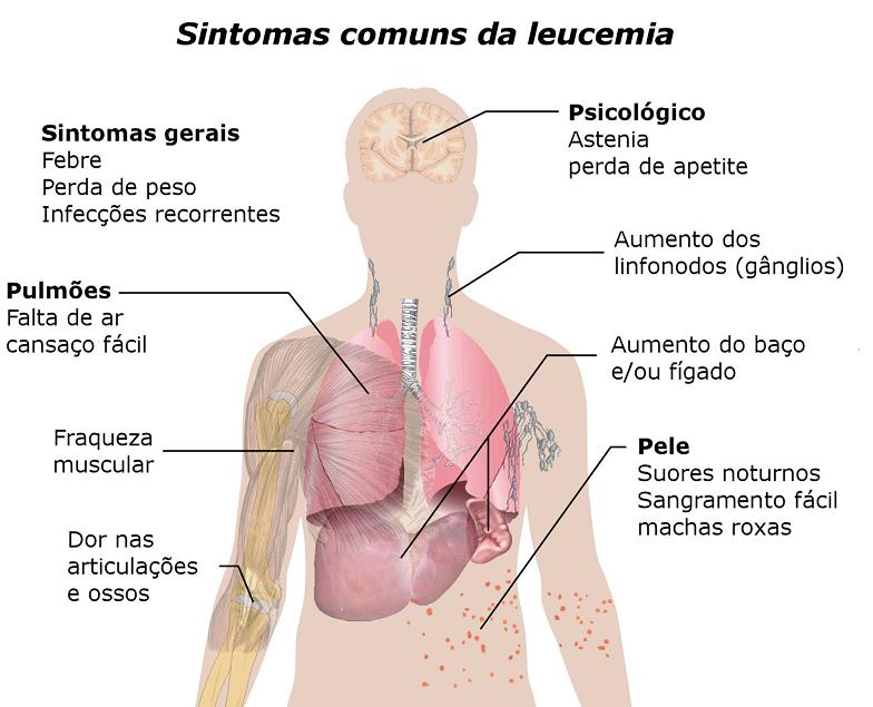 leucemia câncer doença sintomas