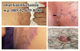 Foto Selangkangan Dan Anus Tumbuh Kutil Kondiloma