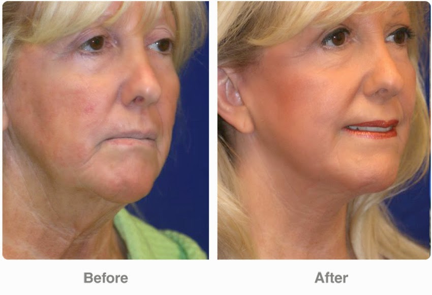 Perfect Body Laser and Aesthetics NonInvasive Neck Lift at Perfect
