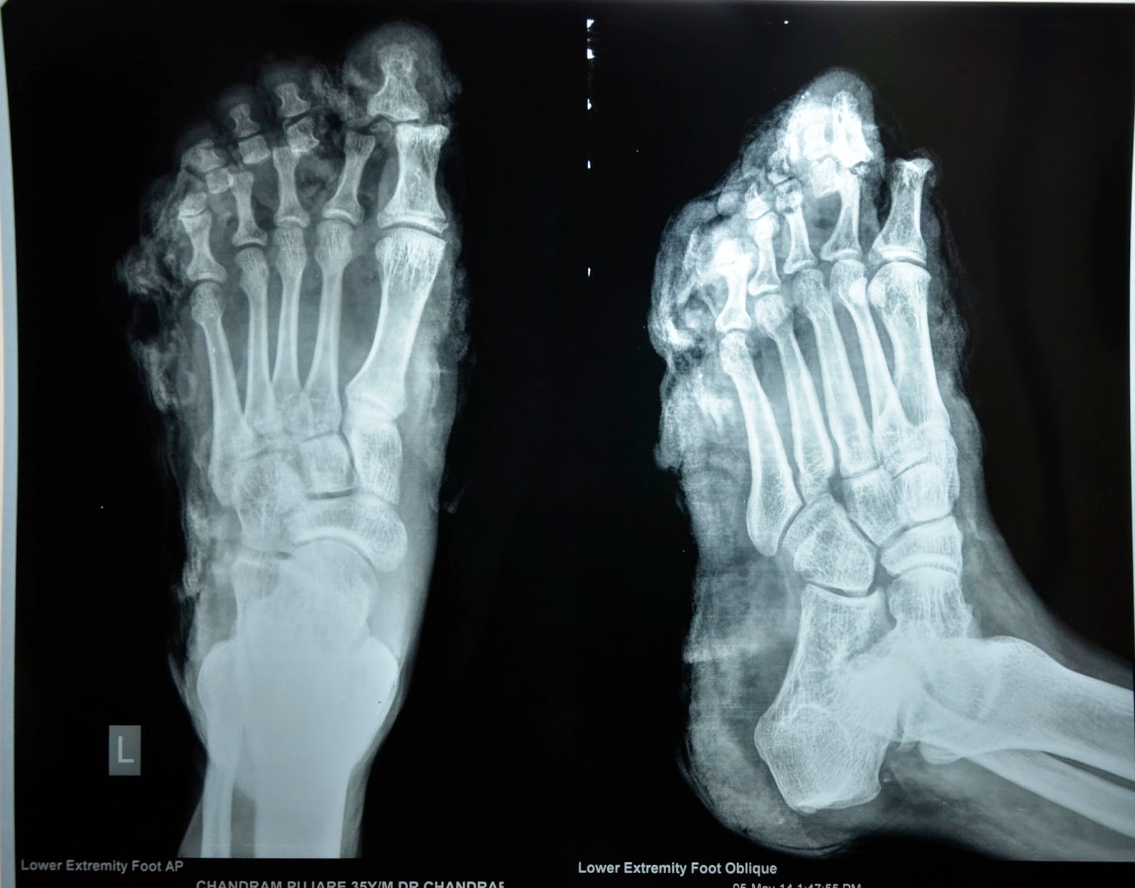 MAJOR CRUSH INJURY FORE FOOT DEGLOVING OF FOREFOOT LATISSIMUS DORSI