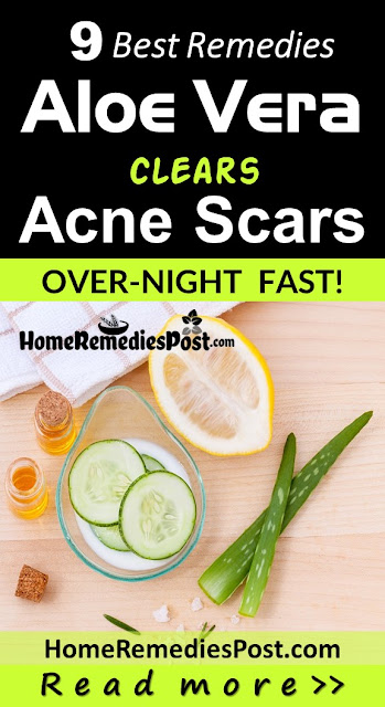 How To Use Aloe Vera For Acne Scars (9 Quick Ways) Aloe Vera For Acne Scars, Aloe Vera Acne Scars, Is Aloe Vera Good For Acne Scars, How To Use Aloe Vera For Acne Scars, Aloe Vera And Acne Scars, How To Get Rid Of Acne Scars, How To Get Rid Of Acne Scars Fast,