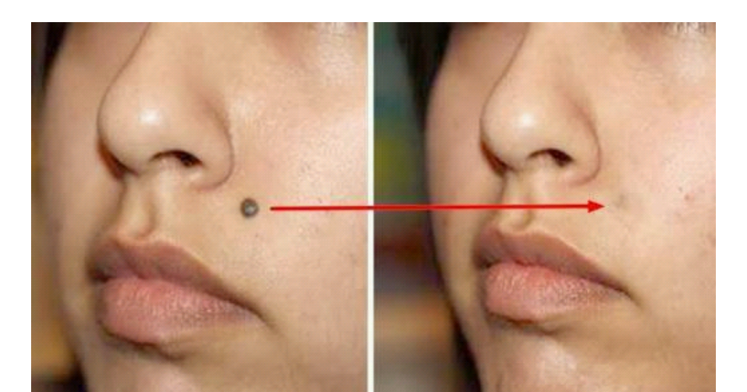 How To Remove Mole At Home