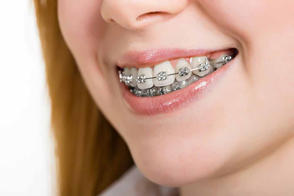 Clear Choice Dental Centre Yokine Top 5 easy ways to reduce braces