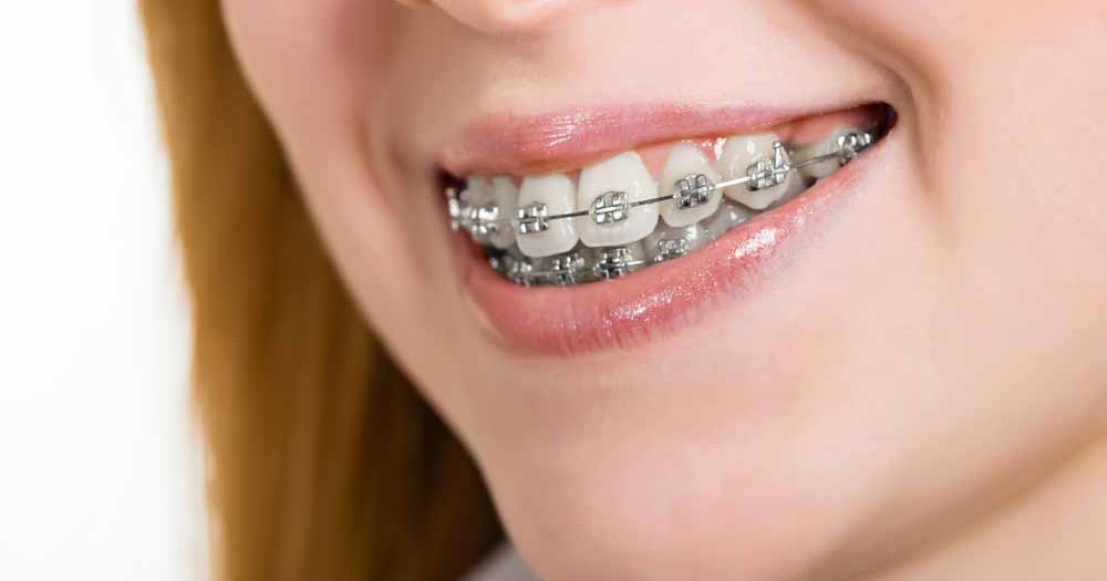 Clear Choice Dental Centre Yokine Top 5 easy ways to reduce braces