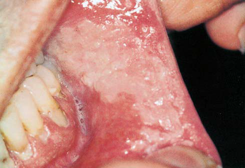 White Oral Lesion 15