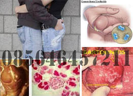 Obat Kemaluan Bernanah Tanpa Resep Dokter