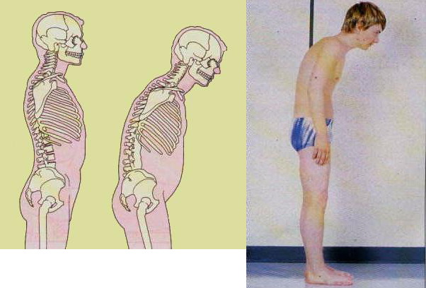 espondilite anquilosante