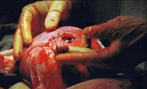 A 21-week-old Fetus Catches The Doctor's Finger From The Uterus During An Operation