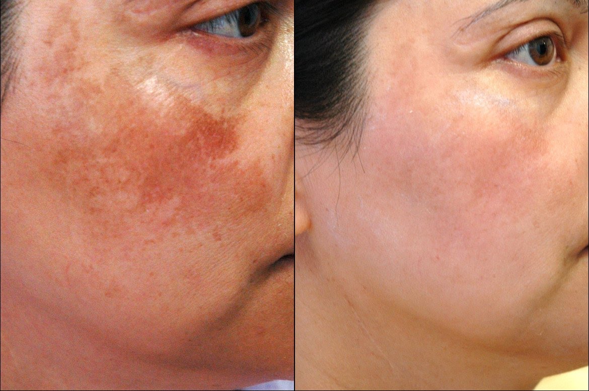 2 Ingredient Remedy To Remove Dark Spots And Pigmentation From Skin