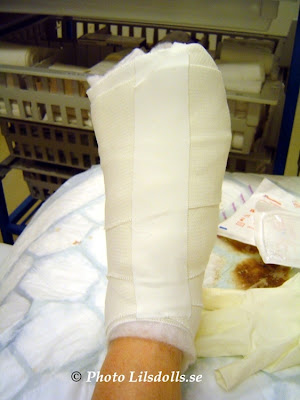 hallux valgus, halluxvalgus-operation, byte av gips