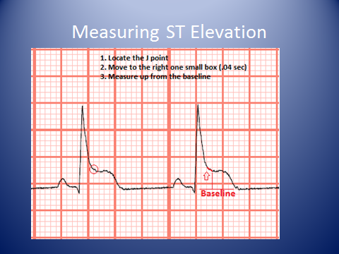 Telemetry Technician Course: Measuring ST Elevation and Depression