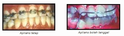tips penjagaan braces, tips penjagaan gigi, cara penjagaan gigi, apa itu ortodontik, braces, pendakap gigi, hukum pakai braces, ustaz azhar idrus, kementerian kesihatan malaysia, myhealth ortodontik, tips gigi putih, video penjagaan braces, apa itu braces, jenis braces, pemakai pendakap gigi, amalan penjagaan gigi braces, gigi besi, lelaki pakai braces, tempoh pakai braces, perkara dilarang memakai braces, rawatan ortodontik, gigi jongang, ubat kumur berfluorida, ubat kumur Listerine, ubat kumur Colgate Plax, lelaki kacak 2014