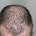 Are you facing Hair loss problem ???