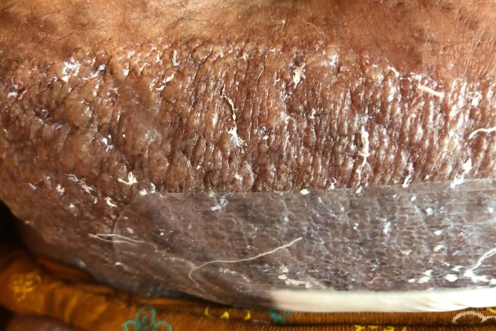 Journal of Postgraduate Gynecology & Obstetrics Surgical Adhesive Dressing induced Allergic