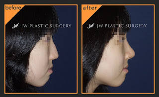 chỉnh sửa mũi lân, mũi khoằm chỉnh sửa mũi lân, mũi khoằm