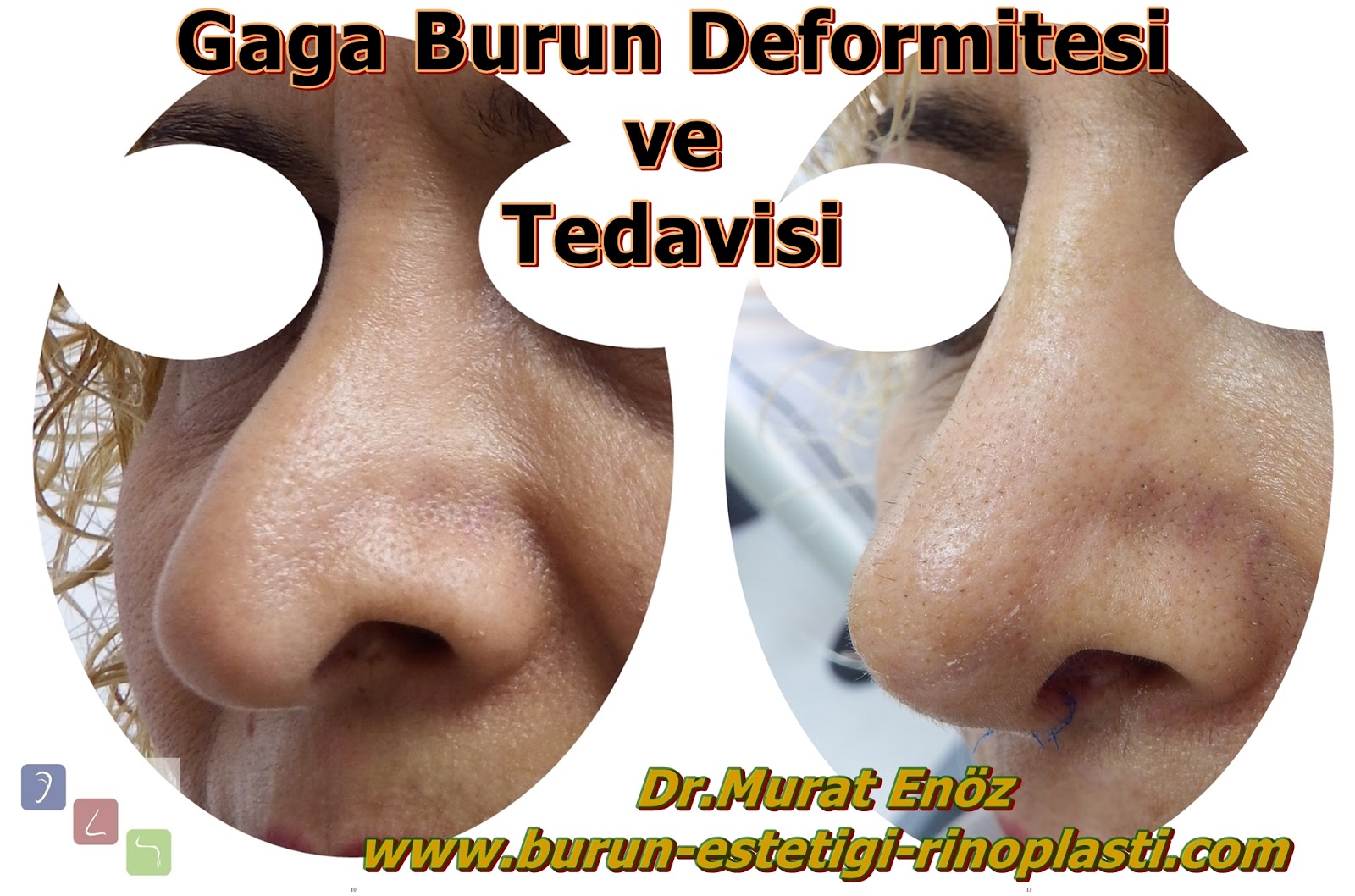 Gaga Burun Deformitesi (Pollybeak Deformity)