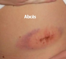 soigner un abcès soigner un abcès