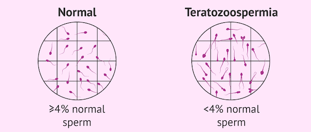 Teratozoospermia / Teratospermia Teratozoospermia / Teratospermia