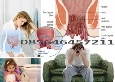 obat wasir aman buat ibu pasca melahirkan obat wasir aman buat ibu pasca melahirkan