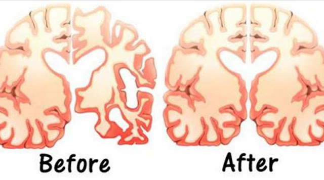 Man Eats 2 Tbs of Coconut Oil Twice a Day for 60 Days and This Happens to His Brain!  Brain