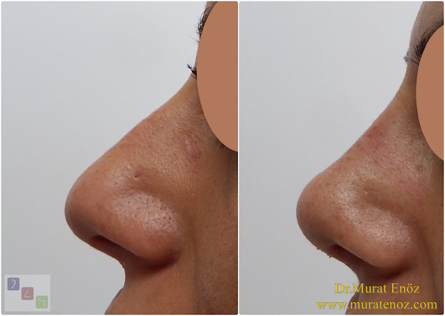 Nasal root filling with subcutaneous tissue - Nasal root filling with underskin tissue - Nose tip plasty - Limited nasal hump removal - Limited nasal hump reduction - Rhinoplasty without breaking the bone - Nose tip plasty in women Istanbul - Nose tip surgery in Istanbul - Nose tip plasty in Turkey