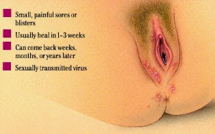 herpes wanita herpes wanita