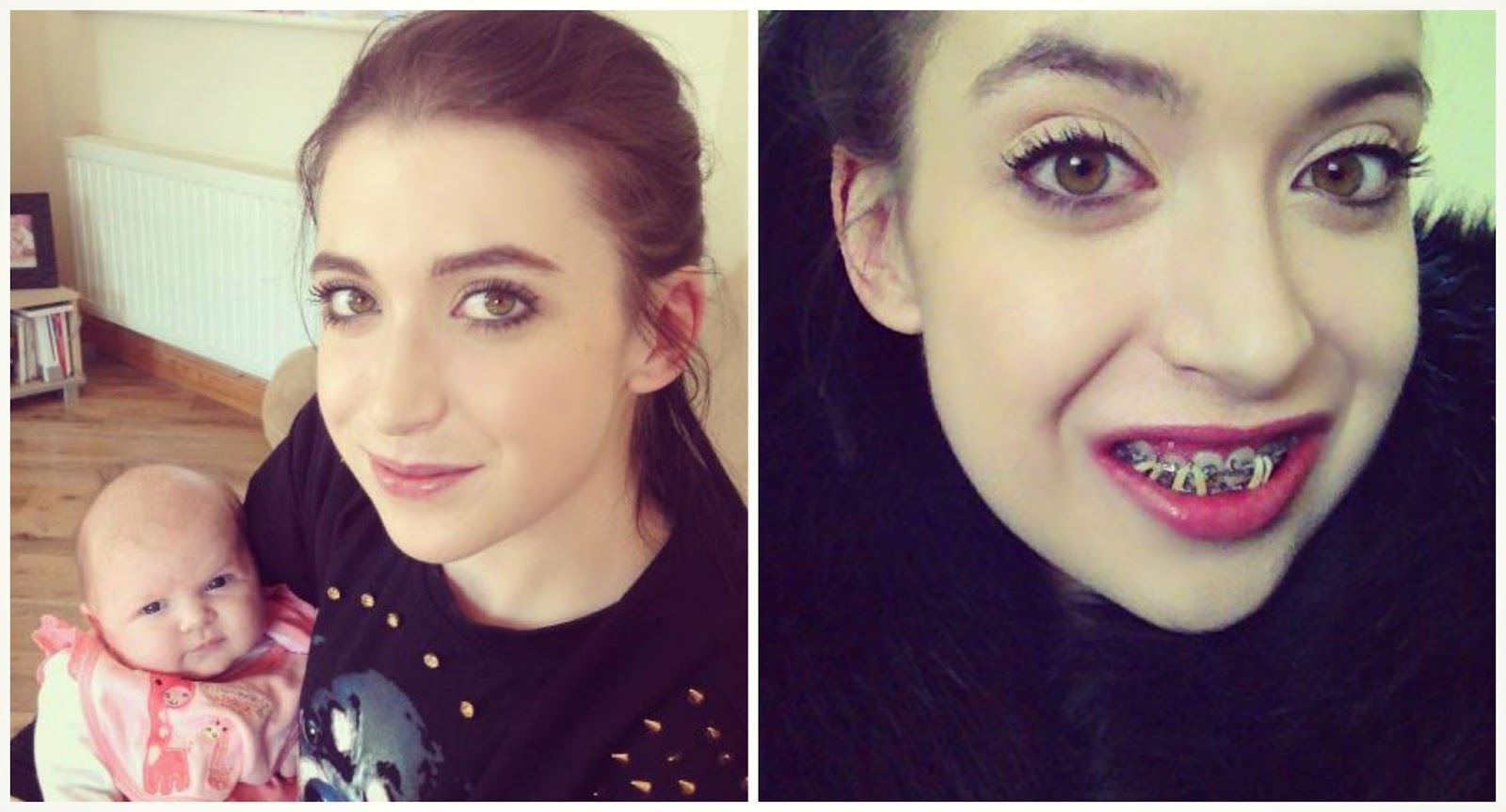 My Underbite Experience. (PostSurgery) Days 2133 THUNDER AND THREADS