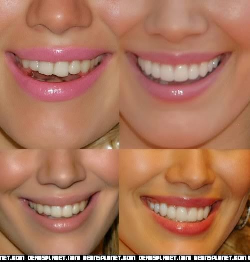 Chiclet Teeth Plastic Surgery Before And After Pictures.