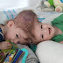 Incredible: Twins Conjoined at the Head See Each Other for the First Time After Historic 27-Hour Surgery