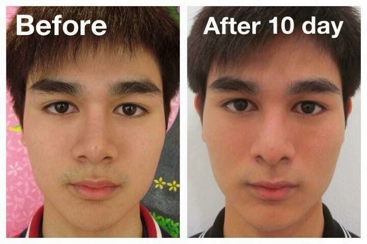 Nose Surgery / Rhinoplasty by Dr.Tanongsak