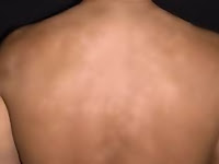 Tips Menghilangkan Panu Secara Alami Tips Menghilangkan Panu Secara Alami