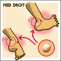 Ampoule au pied Ampoule au pied