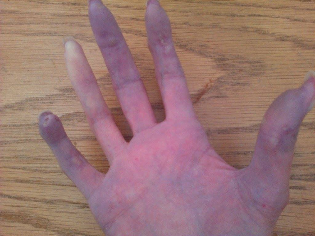 Raynauds Scleroderma Global Patients DAY 7 Raynaud's