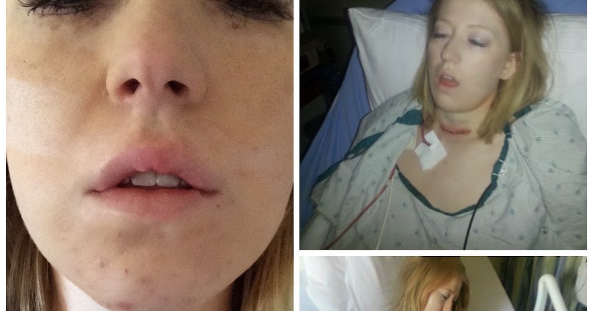 Fashion Flirtation My Thyroidectomy Experience