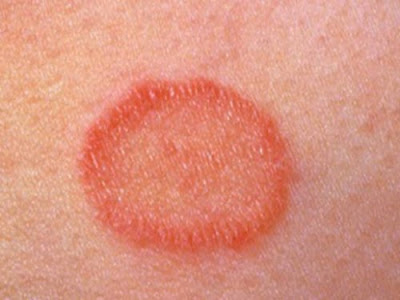 Pityriasis rosé : une éruption cutanée très fréquente Pityriasis rosé : une éruption cutanée très fréquente