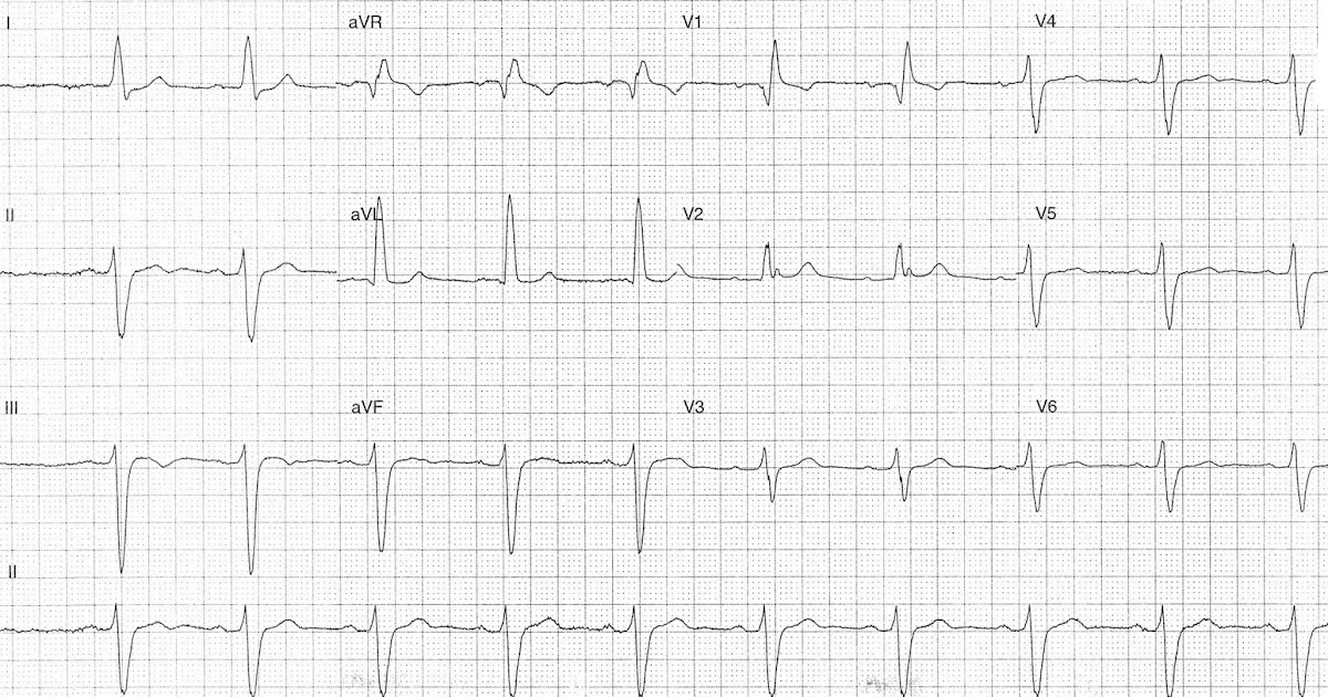 ECG of the Week ECG of the Week 11th December 2017 Interpretation